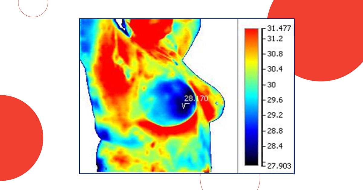 Clinical examples of thermal imaging studies of mastopathy